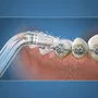 Waterpik WAT0073950290517 Punta de Irrigador Dental para Ortodoncia, Elimina Placa, Especial Aparatos Dentales