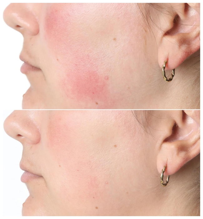 Silk'N Lumino Mascarilla LED de Luminoterapia con 100 LEDs