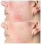 Silk'N Lumino Mascarilla LED de Luminoterapia con 100 LEDs