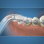 Waterpik Embout Orthodontique