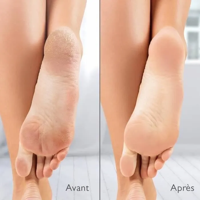 Silk'N Râpe électrique anti-callosités Vacupedi avec aspiration intégrée et 2 râpes Silk'N Râpe électrique anti-callosités Vacupedi avec aspiration intégrée et 2 râpes